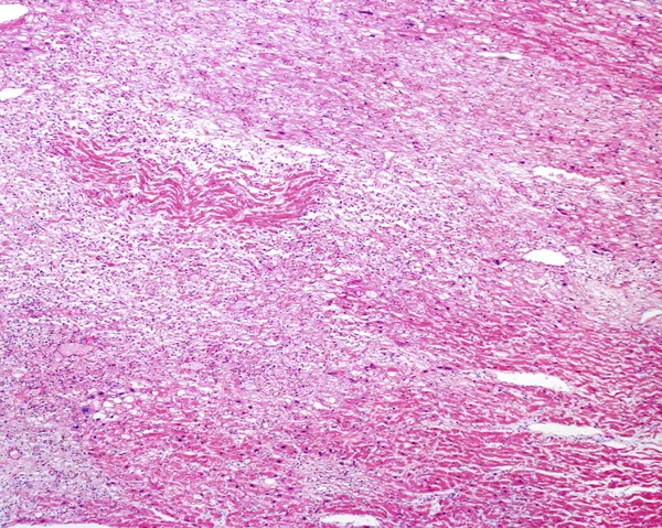 Lichte Micrograaf Van Een Menselijk Hart Met Verschillende Bleke Gebieden — Stockfoto