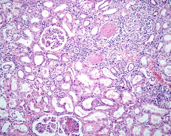 Poliarteritis Nodosa Pan Una Inflamación Necrosante Sistémica Los Vasos Sanguíneos — Foto de Stock