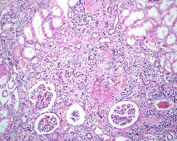 Polyarteritis Nodosa Pan Ist Eine Systemische Nekrotisierende Entzündung Der Blutgefäße — Stockfoto