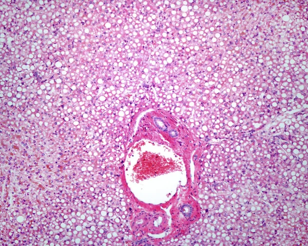 Micrografía Ligera Hígado Humano Con Esteatosis Hígado Graso Esta Condición — Foto de Stock