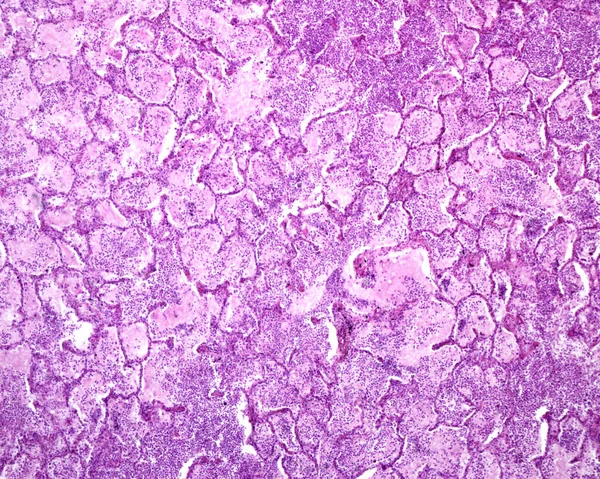 Histologická Část Lidských Plic Postižených Akutní Pneumonií Alveoli Lumen Obsazen — Stock fotografie