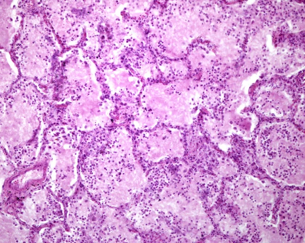 Akciğerin Akut Zatürreeden Etkilenmiş Tarihi Bir Bölümü Alveolün Lümeninde Akut — Stok fotoğraf