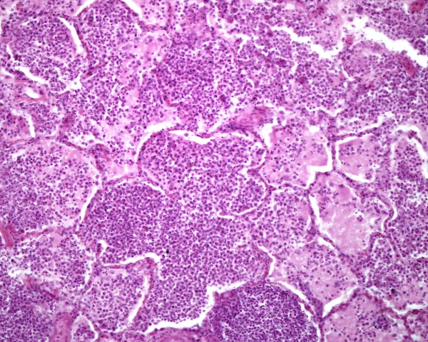 Histologická Část Lidských Plic Postižených Akutní Pneumonií Alveoli Lumen Obsazen — Stock fotografie