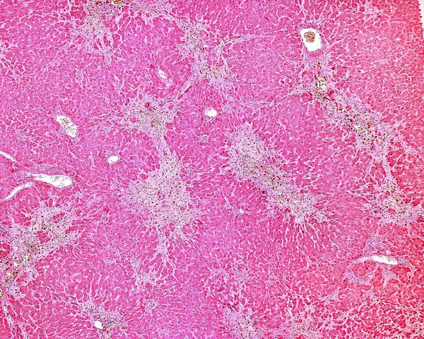 Human liver. Drug-induced liver injury by carbon tetrachloride. Low magnification micrograph showing several clear areas of degeneration and necrosis of hepatocytes with little or no inflammation.
