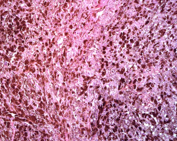 ヒトリンパ節 悪性黒色腫の転移 リンパ節の正常なリンパ組織は完全に消失し 悪性黒色腫色素性および非色素性の細胞に置き換えられた — ストック写真
