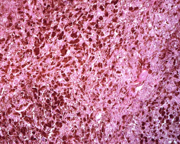 Human Lymph Node Metastasis Malignant Melanoma Normal Lymphoid Tissue Lymph — Stock Photo, Image