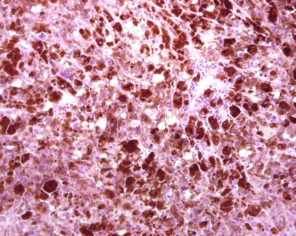 人类的淋巴结 恶性黑色素瘤的转移淋巴结正常淋巴组织已完全消失 取而代之的是恶性黑色素瘤色素细胞和非色素细胞 — 图库照片