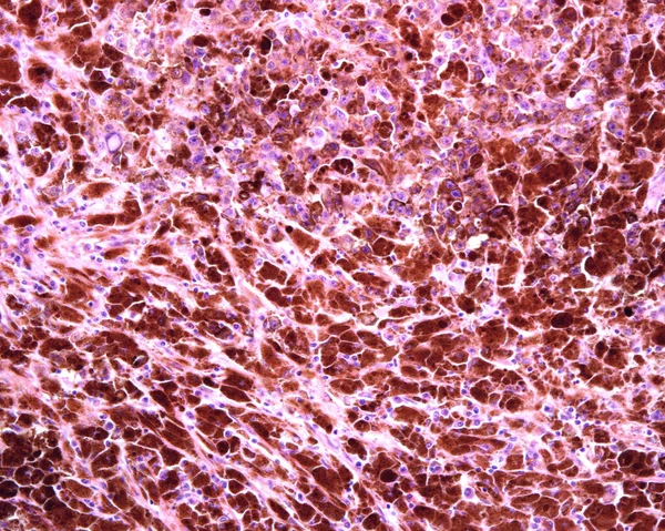 Human lymph node. Metastasis of a malignant melanoma. The normal lymphoid tissue of lymph node has completely disappeared and has been replaced by malignant melanoma pigmented and non-pigmented cells.