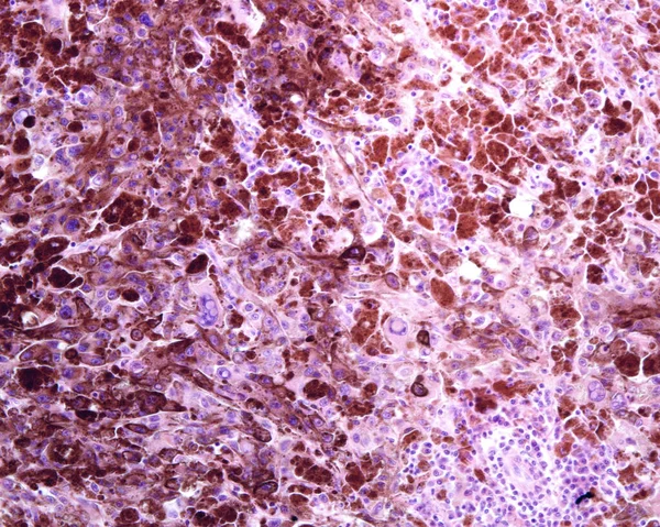 Menschliche Lymphknoten Metastasen Eines Malignen Melanoms Das Normale Lymphgewebe Der — Stockfoto