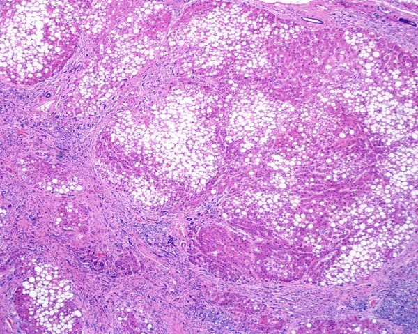 Human liver. Cirrhosis. Low magnification micrograph showing regenerating nodules of hepatocytes (with an extensive fatty change), separated by fibrous septa with chronic inflammatory infiltrates. Cirrhosis of the liver is a result of severe damage t