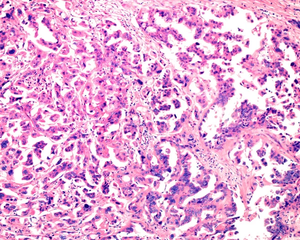 Ovarian mucinous cystadenoma (15-20% of ovarian tumours) is a usually large and benign tumour. But, as shown in this micrograph, it can present cytologic atypia and infiltrative pattern (mucinous cystic adenocarcinoma).