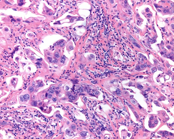 Ovarian mucinous cystadenoma (15-20% of ovarian tumours) is a usually large and benign tumour. But, as shown in this micrograph, it can present cytologic atypia and infiltrative pattern (mucinous cystic adenocarcinoma).