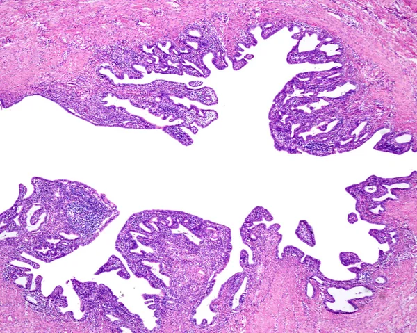 Menselijke Eileiders Getroffen Door Chronische Salpingitis Lumen Van Eileiders Zijn — Stockfoto