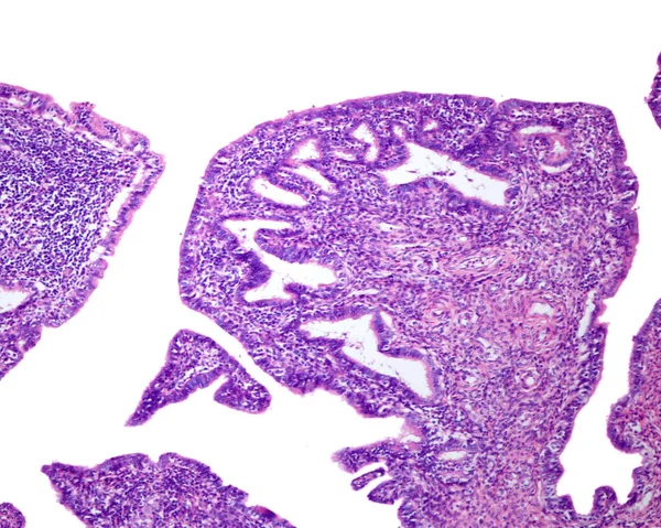 Human Fallopian Tube Affected Chronic Salpingitis Mucosal Folds Widened Shortened — Foto de Stock
