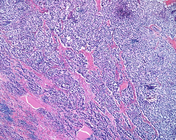 Light microscope micrograph of a seminoma, a germ cell malignant tumour of the testicle. The micrograph shows sheets of clear cancerous cells with a fibrous stromal network. Darker areas are chronic inflammatory infiltrates.