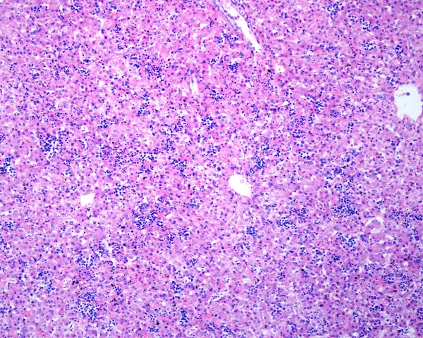 Liver Erythroblastosis Fetalis Characterized Intravascular Proliferation Immature Precursors Erythrocytes Histologically — Photo