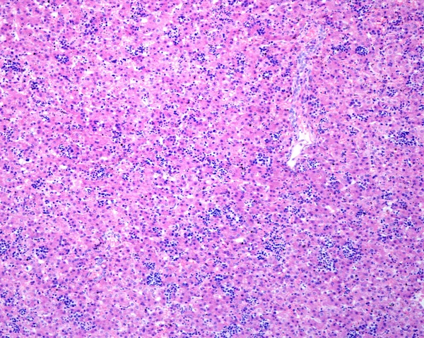 Liver Erythroblastosis Fetalis Characterized Intravascular Proliferation Immature Precursors Erythrocytes Histologically — Photo