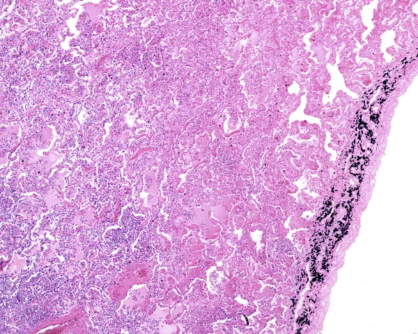 Akut Zatürreeden Etkilenen Bir Insan Ciğeri Çevresi Alveolün Lümeni Akut — Stok fotoğraf