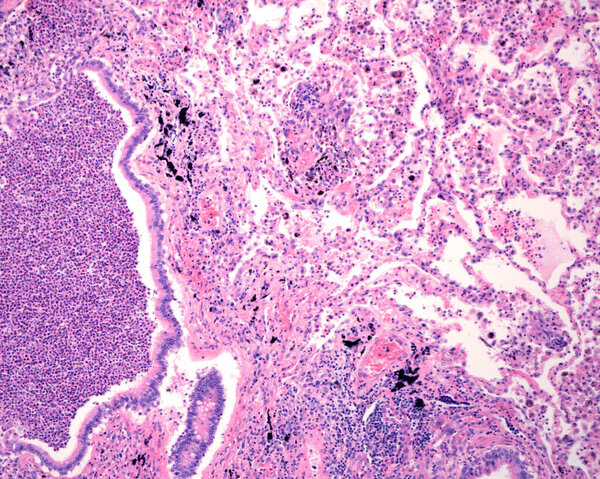 Human lung affected by an acute bronchopneumonia, commonly a hospital-acquired bacterial pneumonia. The lumen of alveoli is occupied by liquid of oedema which contains acute inflammatory infiltrates (with predominance of neutrophil granulocytes). On 