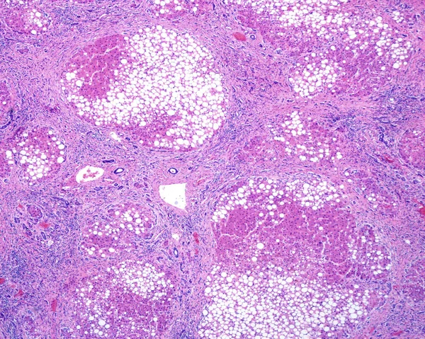 Human liver. Cirrhosis. Low magnification micrograph showing regenerating nodules of hepatocytes (with an extensive fatty change), separated by fibrous septa with chronic inflammatory infiltrates. Cirrhosis of the liver is a result of severe damage t