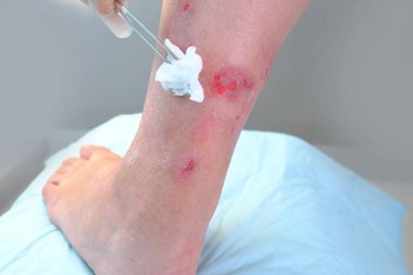 Bayan doktor asistanı bacağında sıyrıklar, yaralar, egzama, bacağında deri yüzülmüş kadını muayene edip tedavi ediyor. Yaraları kanıyor. Tıbbi bakım kavramı, tırmalama yaraları, kendine zarar verme.