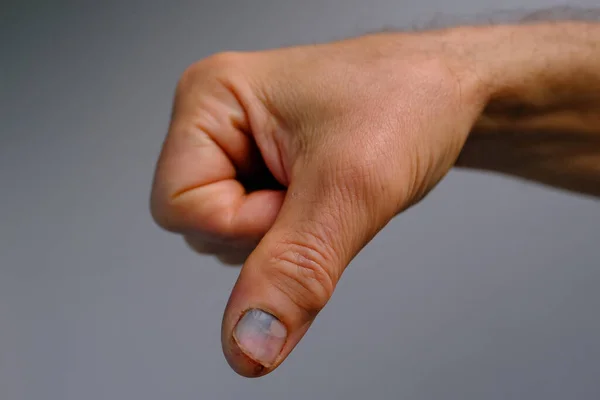 Τραυματίας Άντρας Κοντά Στο Χέρι Ατύχημα Δάχτυλο Του Αντίχειρα Μώλωπας — Φωτογραφία Αρχείου