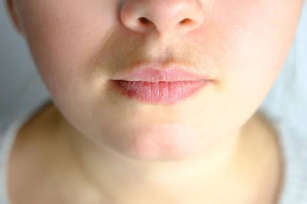 在安装牙托 唇上有疱疹的女孩 概念化妆品程序 消除年龄斑点 面部毛发之前 对年轻妇女的弯曲牙齿进行特写 — 图库照片