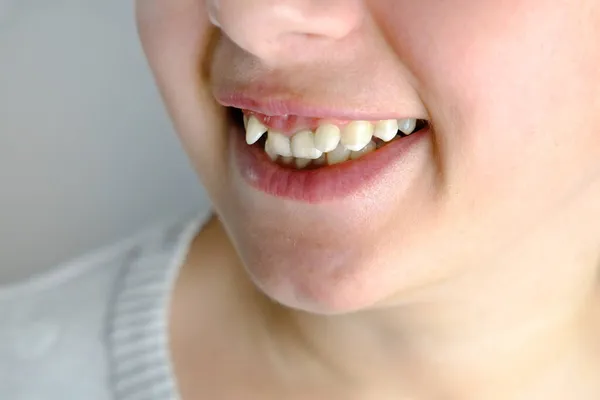 Zbliżenie Zakrzywionych Zębów Młodej Kobiety Przed Instalacją Aparatu Ortodontycznego Dziewczyna — Zdjęcie stockowe