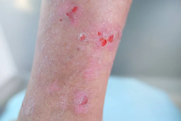 Asistente Médico Mujer Examina Trata Mujer Pierna Con Arañazos Cicatrices —  Fotos de Stock