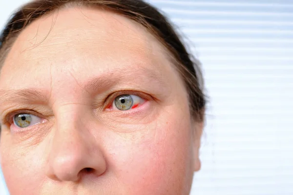中年妇女近视部分面部50 55岁 人眼挫伤 血管爆裂 监视概念 视力检查 医疗程序 — 图库照片