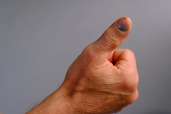 損傷した男性の手を閉じる 親指の指の損傷事故 爪に打撲 安全違反の概念 応急処置 職場での労働保護の違反 — ストック写真