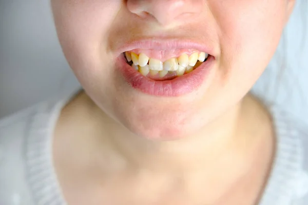 Крупным Планом Изогнутые Зубы Молодой Женщины Перед Установкой Брекетов Девушка — стоковое фото