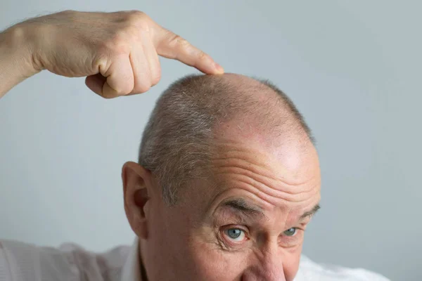 特写镜头老秃头魅力成熟男子显示他的头发从头上脱落 病人的脱发诊所 主题是男人脱发 有选择的焦点 秃头男子的抗衰老治疗 — 图库照片