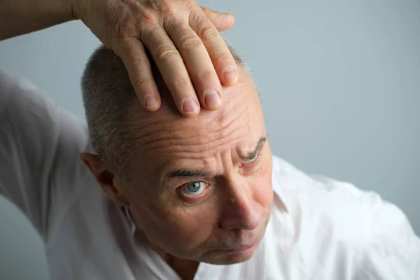 特写镜头老秃头魅力成熟男子显示他的头发从头上脱落 病人的脱发诊所 主题是男人脱发 有选择的焦点 秃头男子的抗衰老治疗 — 图库照片