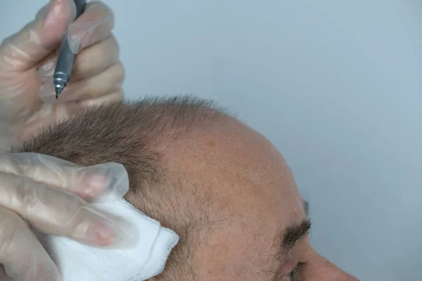 Close Trichologist Trata Paciente Homem Maduro Careca Com Alopecia Clínica — Fotografia de Stock