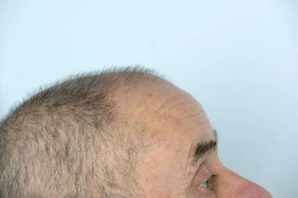 髪の毛の成長クリニックで脱毛症の患者 はげ成熟した男性を治療し 男性を脱毛させるためのアンチエイジング治療 男性のための毛髪移植手術の概念選択的焦点は — ストック写真