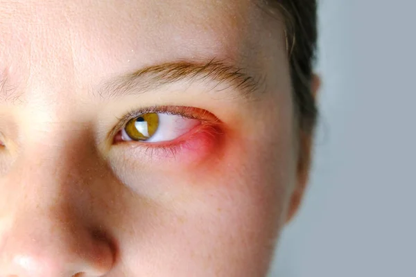 Hasarlı Hasta Bir Kadının Gözlerini Iyileştirir Yüzünün Bir Kısmını Kapatır — Stok fotoğraf