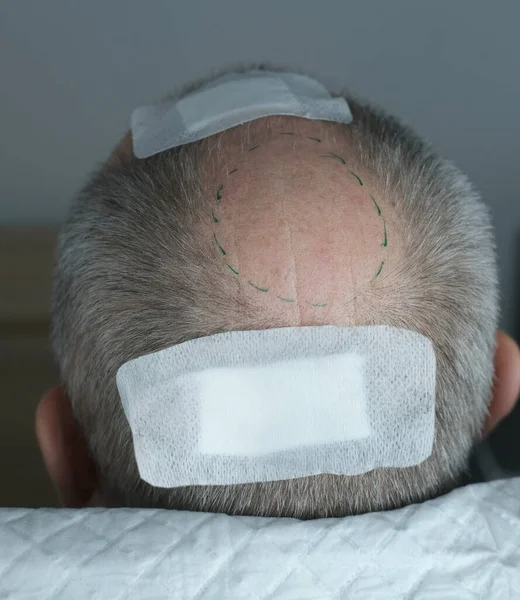 Detailní Tricholog Léčí Pacienta Plešatého Zralého Muže Alopecií Klinice Pro — Stock fotografie