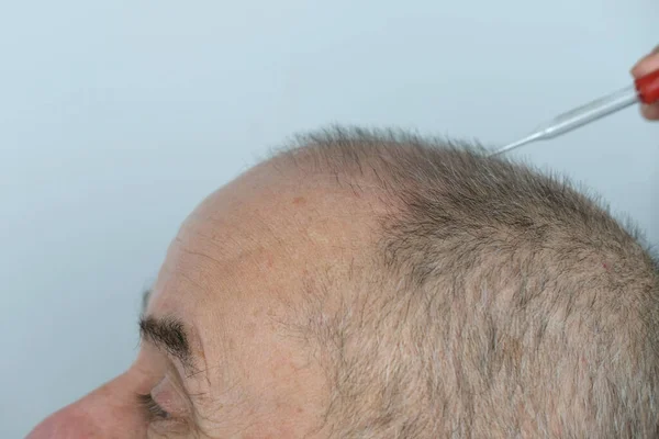 Close Tricholoog Behandelt Patiënt Kale Volwassen Man Met Alopecia Haargroei — Stockfoto