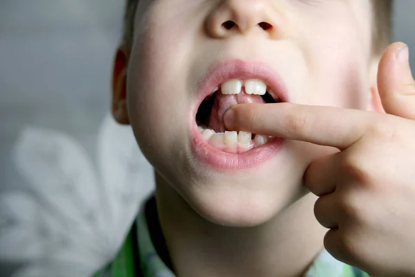 Cavidade Oral Paciente Pequeno Comprimento Frênulo Língua Menino Criança Realiza — Fotografia de Stock