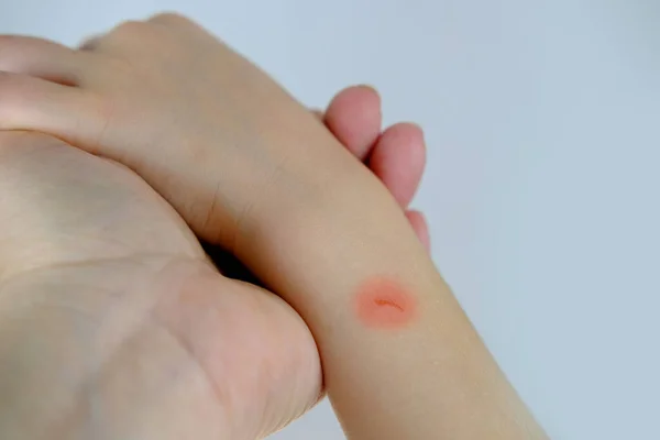 Close Wound Scratch Children Skin Mom Examines Her Son Hand — Stock Photo, Image