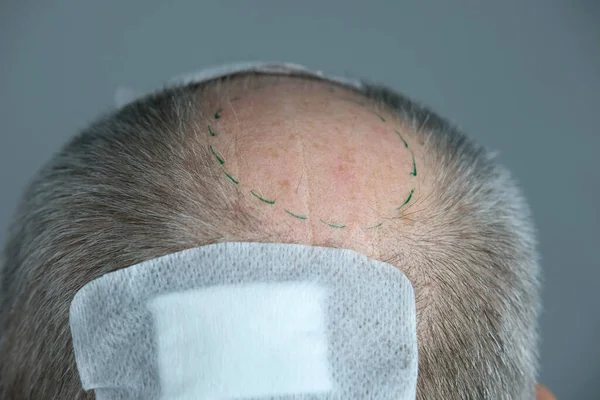 close-up trichologist treats patient, bald mature man with alopecia in hair growth clinic, anti-aging treatments for balding men. concept of hair transplant procedures for men, selective focus