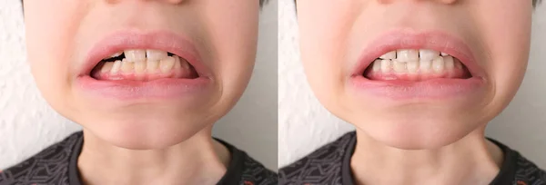 Bambino Bambino Mostra Dente Che Ondeggia Male Concetto Odontoiatria Pediatrica — Foto Stock