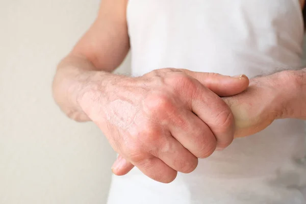 Close up of male hands with dry skin damage, applying moisturizer. Dermatology concept human hands with skin with cracks and wounds, skin treatment, aging hand skin care