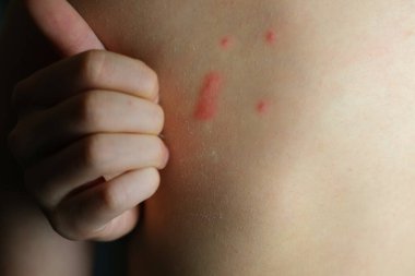 Çocuğun çıplak sırtı, 8 yaşında kırmızı papüller, sivrisinek ısırıkları, deri tahrişleri, alerjik döküntüler, çocuk sağlığı konsepti, vücut bakımı, pediatri.