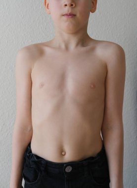 Sıska bir çocuk, 8 yaşında çıplak gövdeli bir çocuk önünde duruyor, iyi duruş, çocuklukta skolyozu önleme, işitme sağlığı kavramı, mutlu çocukluk, anoreksiya