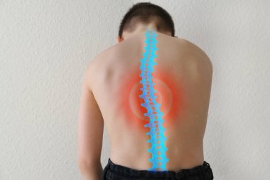 Oğlanın çıplak sırtı, 8-10 yaşlarında, kavisli omurga, omurgadaki ağrının sembolü olarak kırmızı nokta, osteokondrosis, skolyoz, sırt ağrısı, omurgalar arası fıtık için tedavi edici masaj konsepti