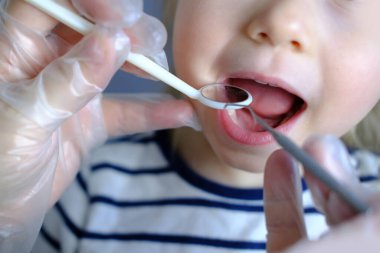 Dişçi, doktor küçük bir hastanın ağız boşluğunu inceliyor, ağız aynası kullanıyor, bebek dişlerini kapatıyor çocuk, konsept pediatrik dişçilik, diş tedavisi, tıkanıklığın düzeltilmesi, ağız bakımı, kalp bakımı
