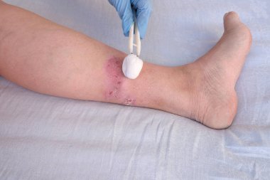 Doktor alt bacağındaki büyük iyileşme yaralarını yetişkin kadın hastaların yaralarıyla, kızarıklıklarla, deri yaralarıyla, tıbbi bakım konseptiyle, insan dokusu rejenerasyonuyla, kadın ayaklarında haşlanmayla tedavi ediyor.