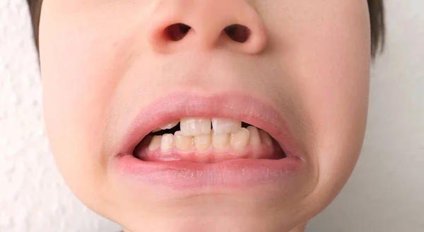 Παιδί Παιδί Δείχνει Δόντι Που Ταλαντεύεται Και Πονάει Την Έννοια — Φωτογραφία Αρχείου
